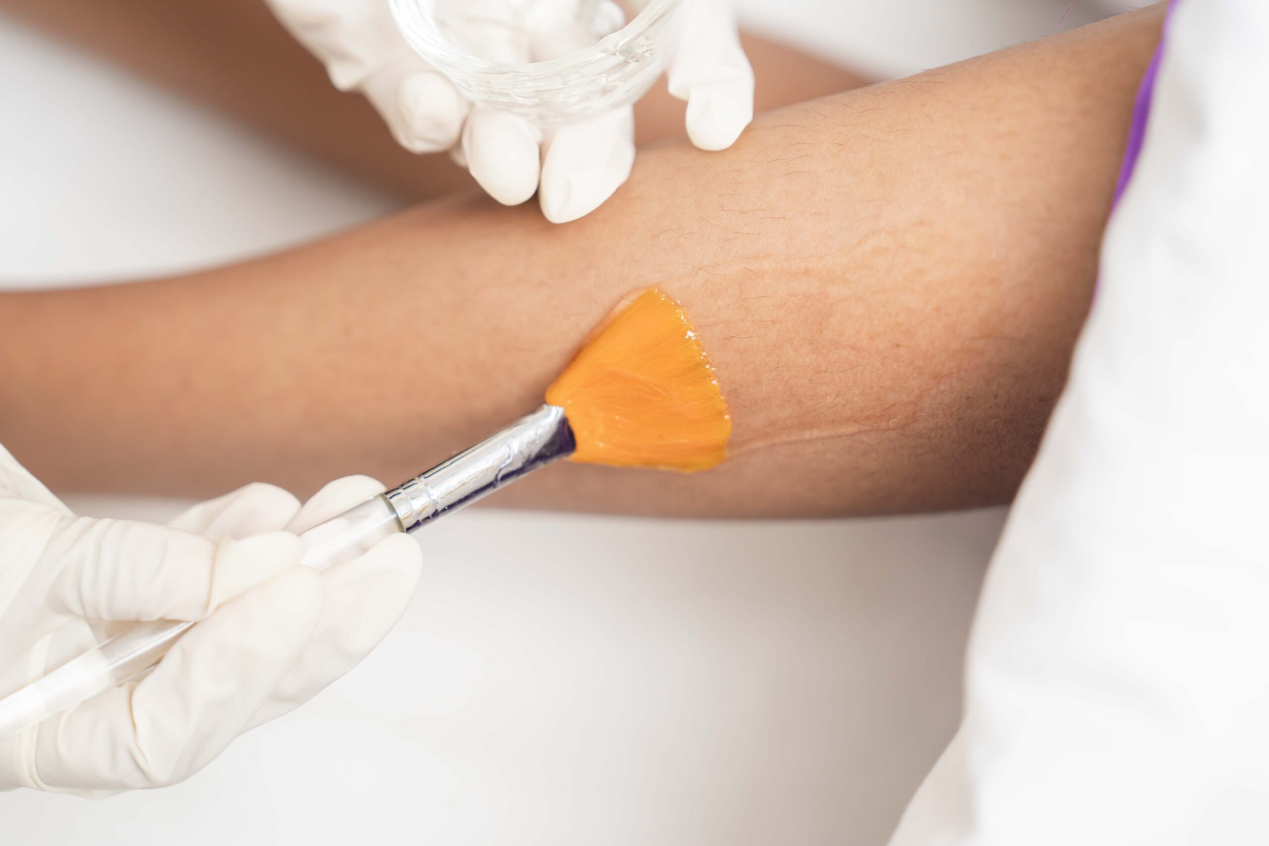 Mackcare Skin Clinic: Doctor applying pre-treatment solution for IPL SHR hair removal on client's arms.